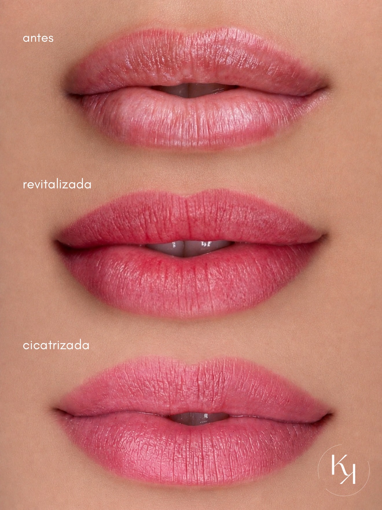 Resultado Revitalização Labial