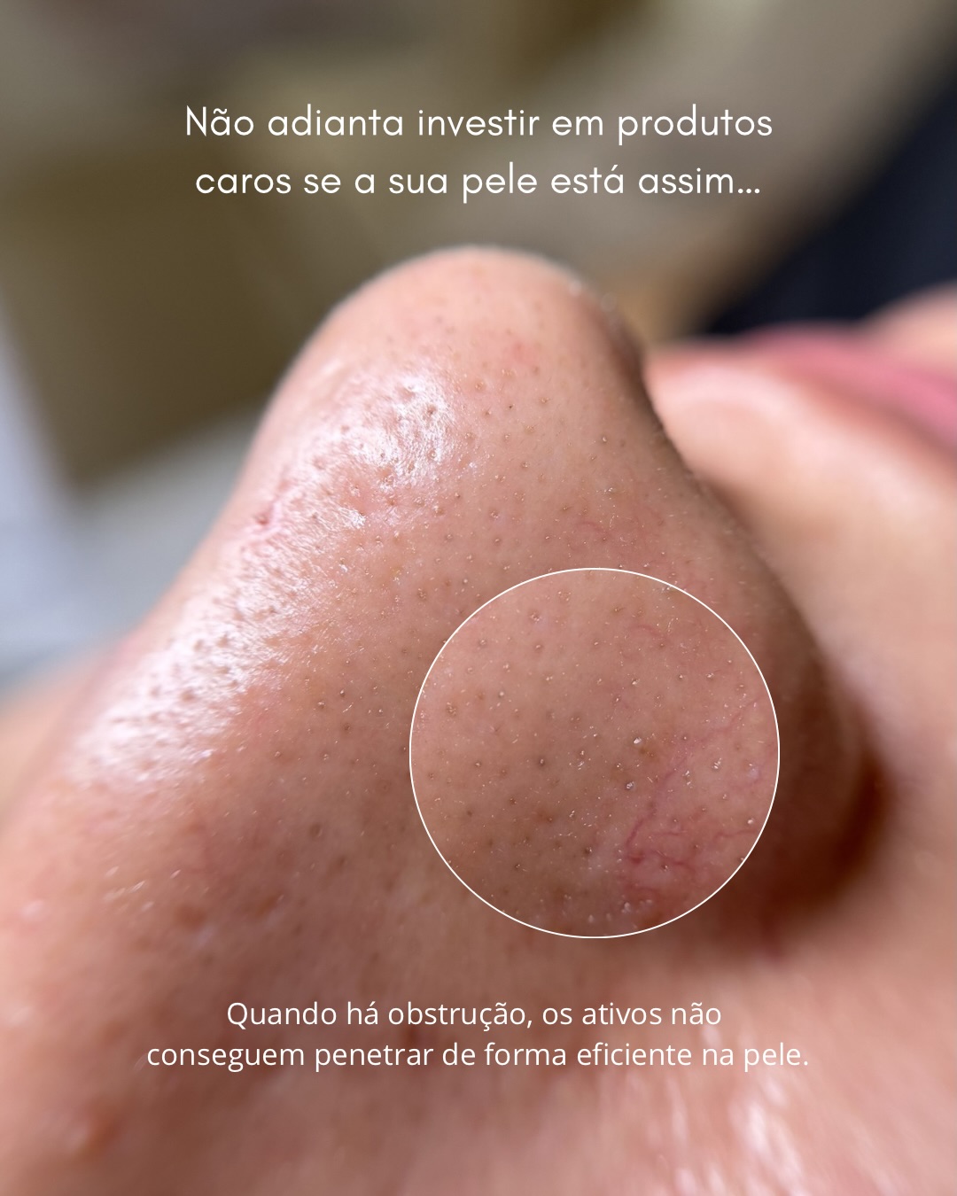 Resultado Limpeza de Pele